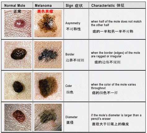 身上有很多痣|痣也可能会癌变！长在 3 个地方要注意